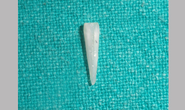 Veneerscrown and bridges treatment in Anand
                        